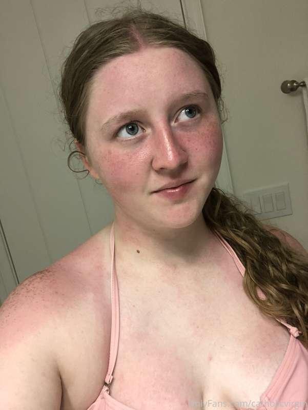Went to the beach and got a little too much sun🤣 This sunbur..