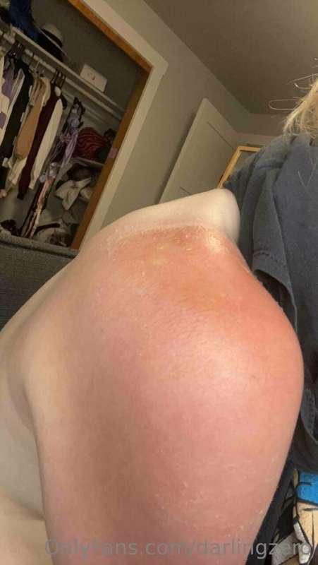 I think i'll avoid the sun for a while 🌞🌞🌞