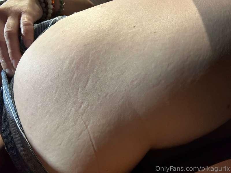 Stretch marks
