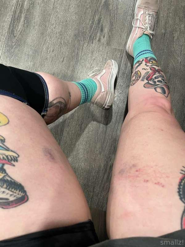 showing off these bite marks at the gym while hiding a cute ..