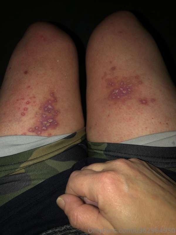 My rash is finally getting better a little bit it doesn't hu..