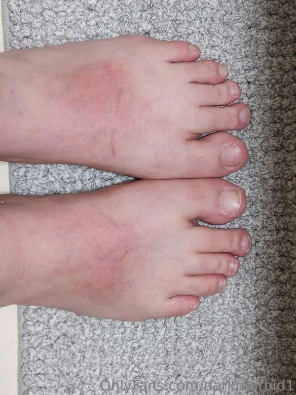 Yokes got sunburned on my feet 😬