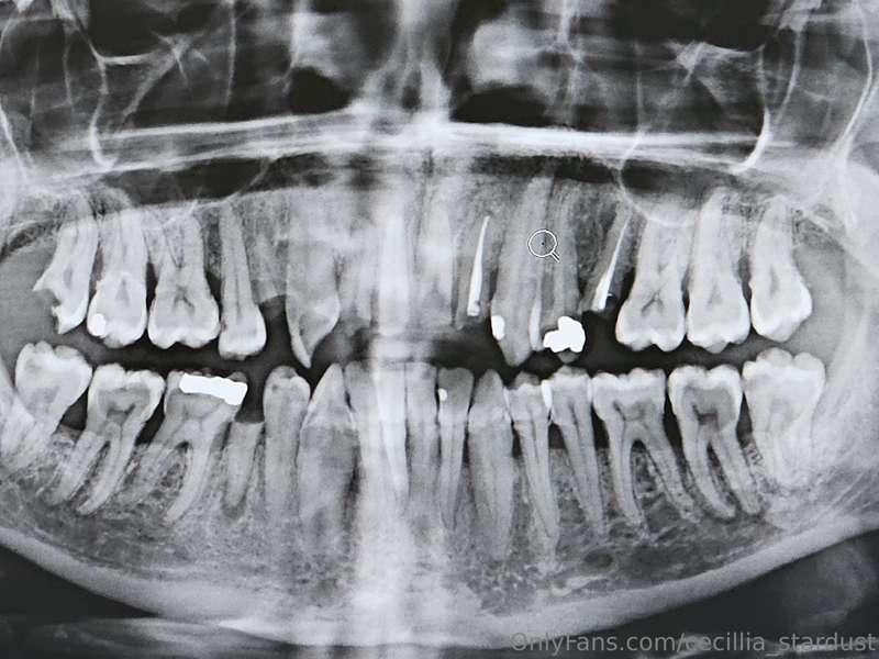 TW: Teeth/Dentist 

Here's a post I'd never thought I'd make..