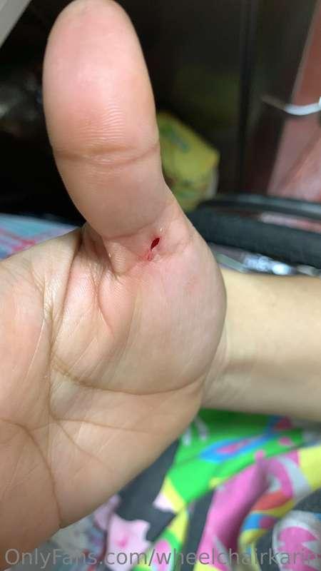 I'm sorry for the delay honey I had a little accident and cu..