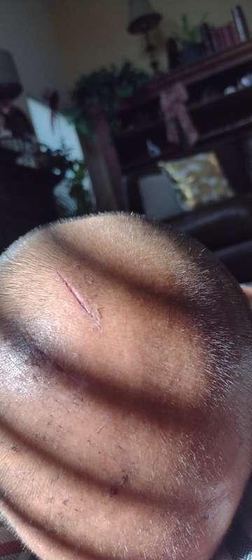 This past thanksgiving I sprained my neck and shoulder blade..