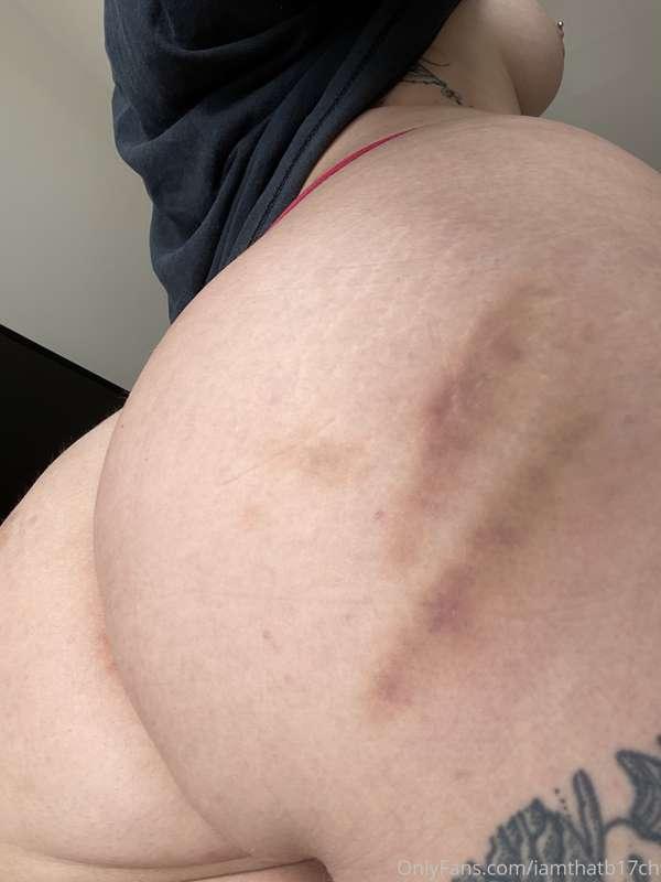 We love bruises from daddy