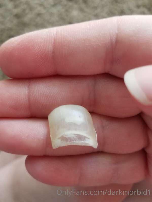So 2 months ago I drop a mug on my big toe and today the toe..