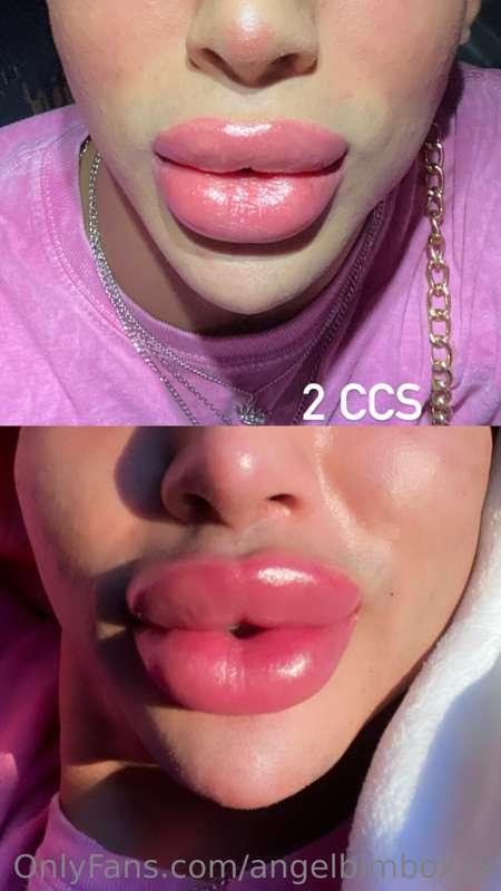 Latest lip augmentation (2 cc)