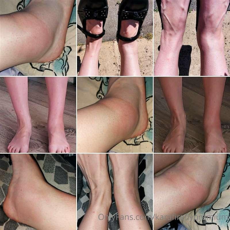 Stupid skinny weak ankles! On Monday my ankle gave way as I ..