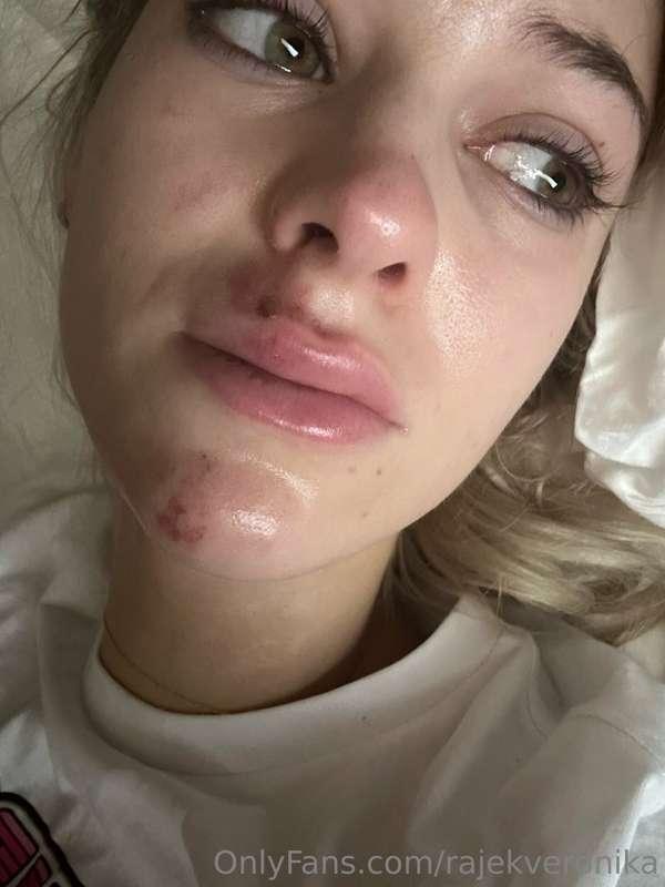 This so hard to share 😢😢❤️‍🩹

I had bad accident from scoote..