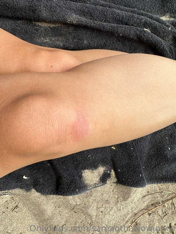 Okay that’s kinky- knee bruises from naughty fun at the nude..