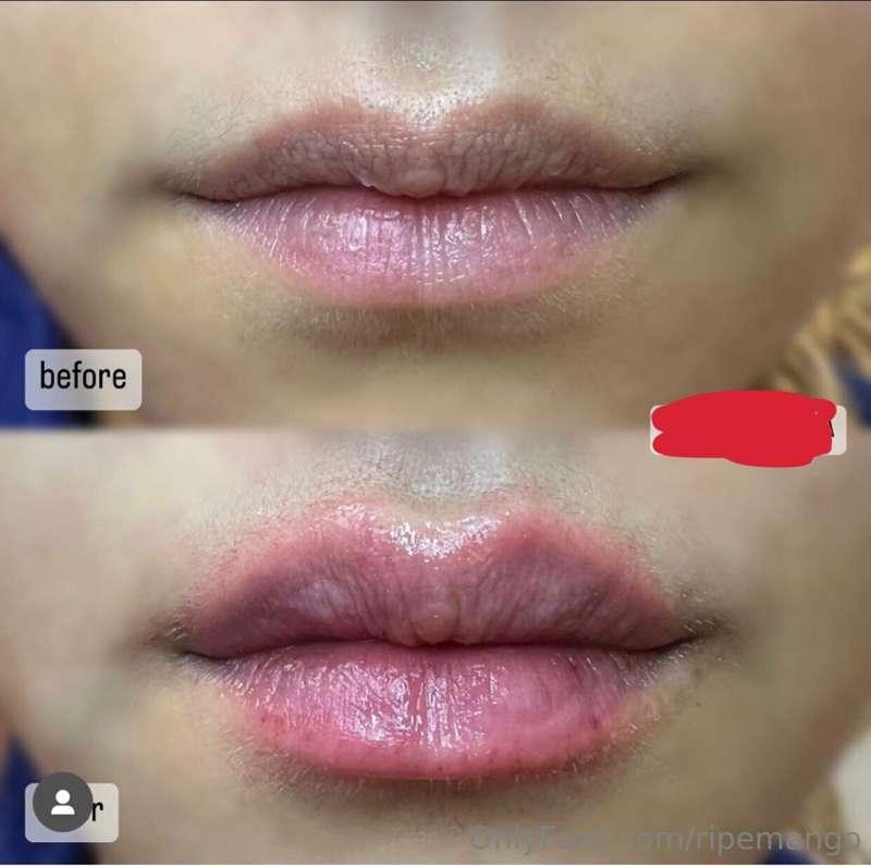 Got lip filler☺️if you want to see more check your inbox