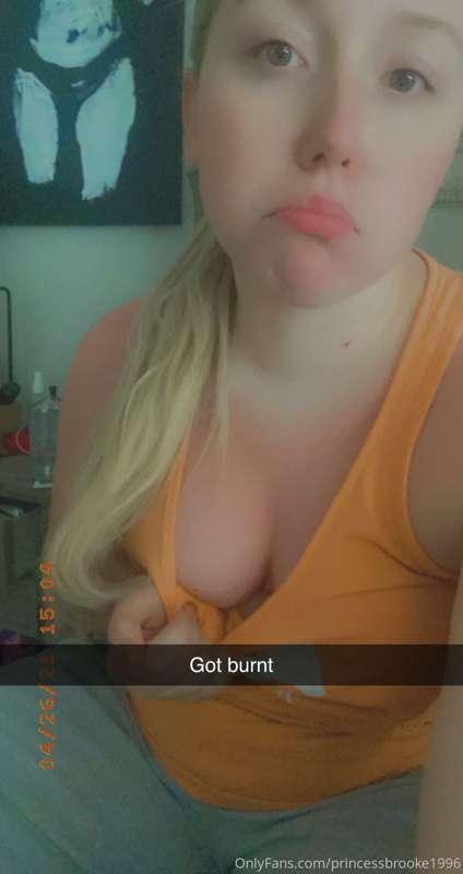 Come kiss my sunburn 💋☺️