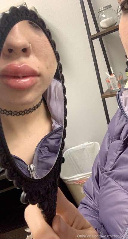 Just got more lip filler 👄 Tip if you love my big fake lips ..