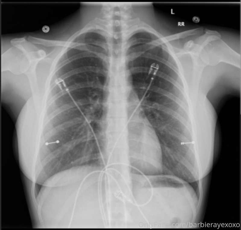 X-ray tits yum