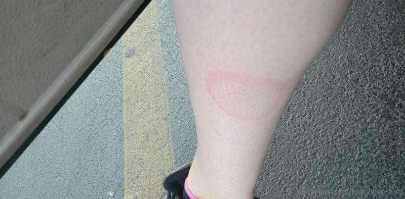 Leave it to burn the shit out of myself on a motorcycle exha..