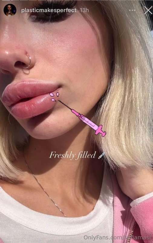 Just filled my lips 👄 they look so plump🥰 #juicylips