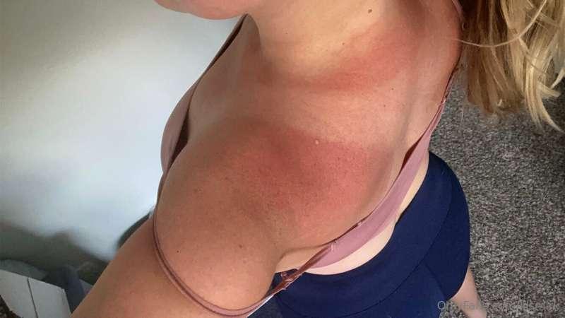 Sun burn and now I need a rub down.