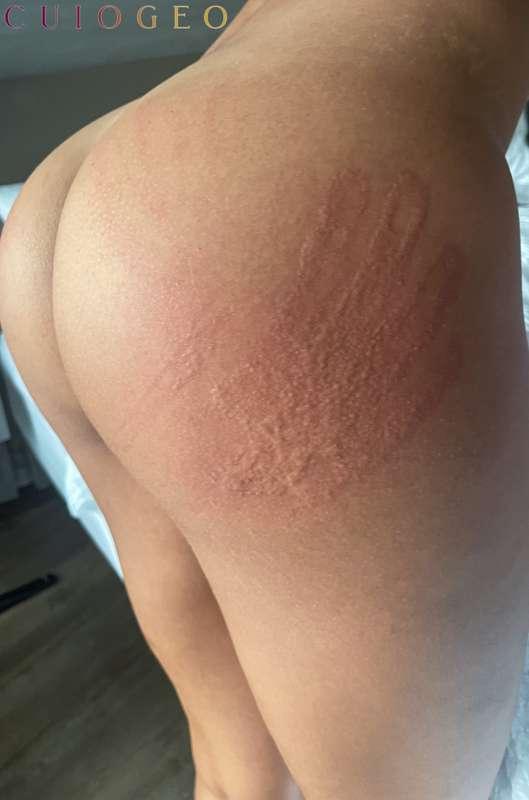 Randy & Faye D1:

Randy bruises so well that my handprint is..
