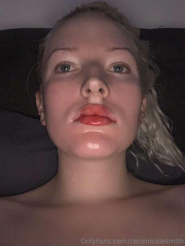 I got more lip injections😳 that’s why I haven’t posted in a ..