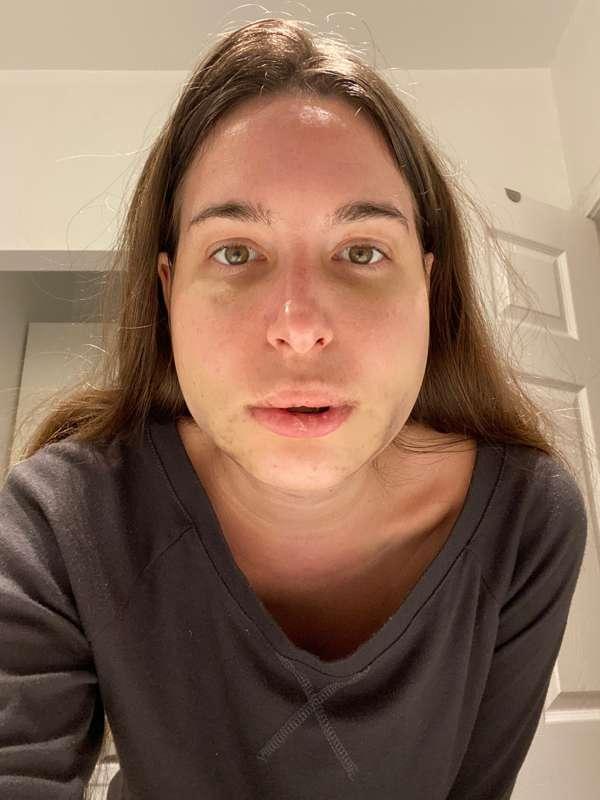 A little update on my face and how I’m feeling (day 3). I fi..