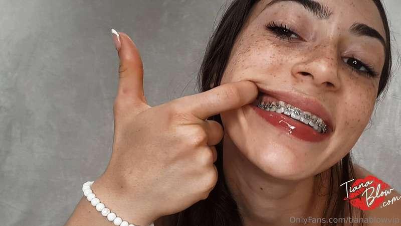 Do you love my brace face 😁 💗💗 https://onlyfans.com/84327885..