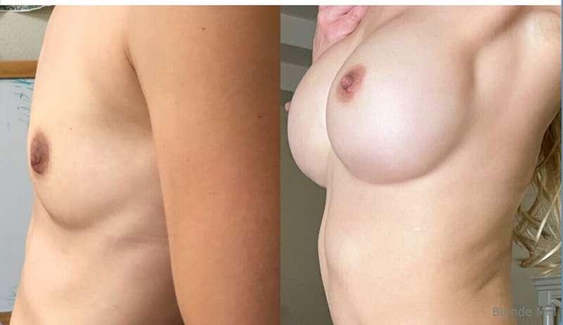 I’ve had a few questions about what my boobs looked like pre..