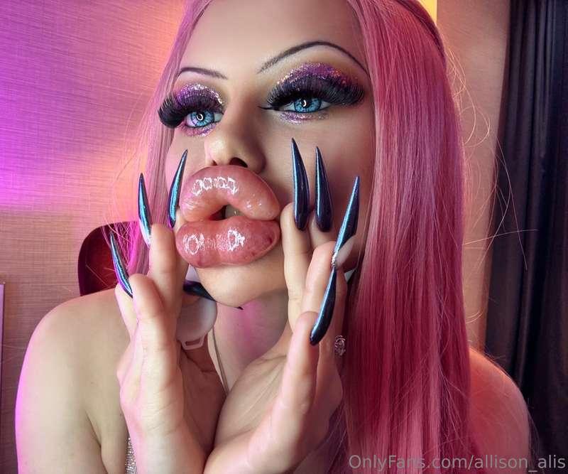 𝘽𝙄𝙈𝘽𝙊 𝘽𝙄𝙂𝙂𝙀𝙎𝙏 𝙎𝙒𝙊𝙇𝙇𝙀𝙉 𝙇𝙄𝙋𝙎 𝙀𝙑𝙀𝙍💉🩷Just injected bruised lips ..