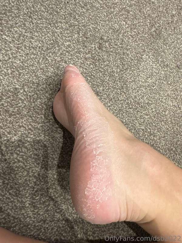 I’ve been out of action 🚫Because I stupidly did a peel off f..