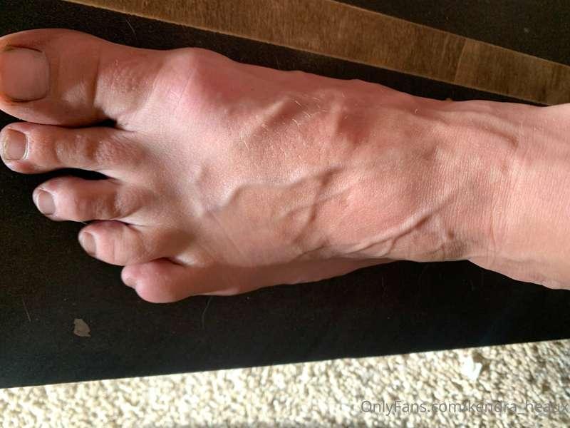 Bulging feet & veins