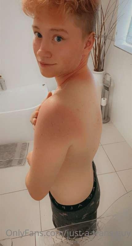 I may have gotten a wee bit burnt the other day 😅