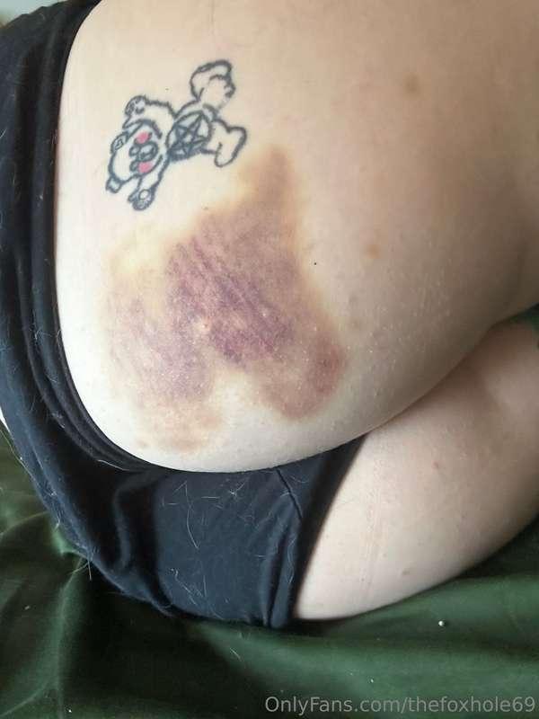 I took these photos for myself awhile ago but the bruises ar..