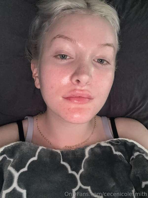I got some lip filler today!!!!