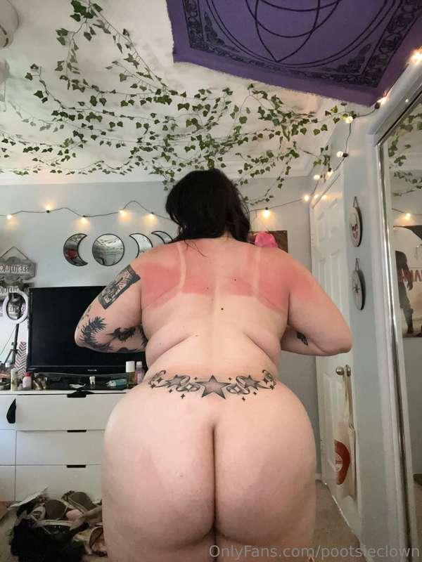 horrendous sunburn