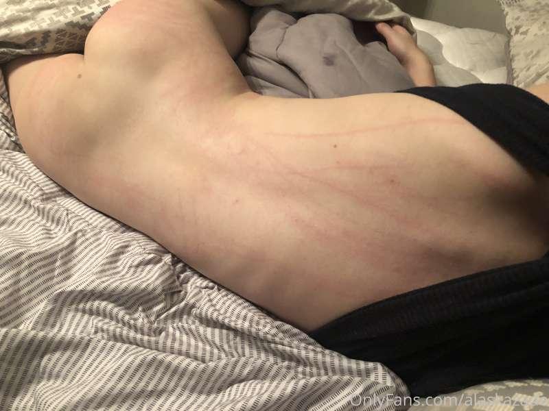 My skin is super sensitive so I always get a ton of marks.  ..