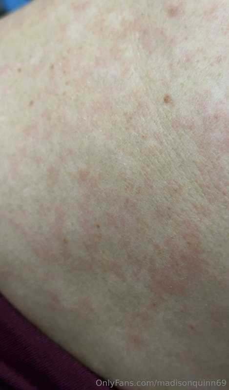 Sorry I couldn’t do the live last night I had an allergic re..