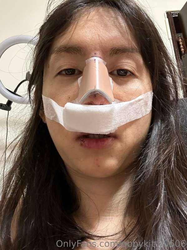 Hey dear all, i do nose sugery yesterday
So please give me s..