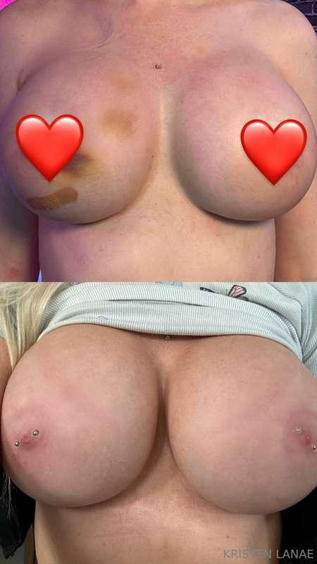 ok but isn’t this CRAZY?1 week post op on top and bottom is ..