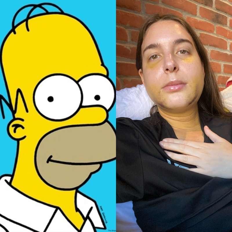 Another update on my surgery 😭 I’m slowly turning into Homer..