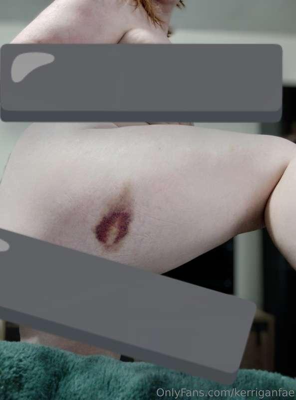 The bruise has gotten worse. I only wish it was from somethi..