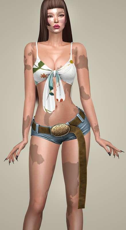 Vitiligo Eden Body-Face