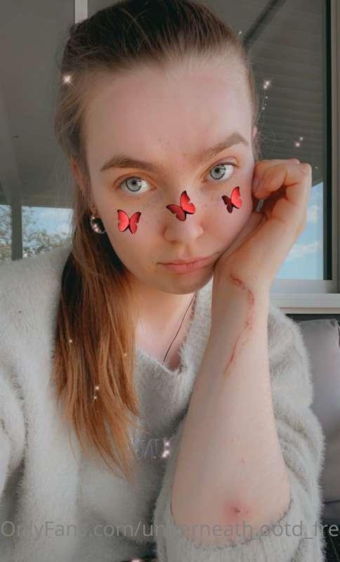 Sorry I've not been posting babe... I had an accident 😣

I'm..