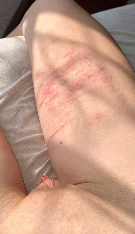 Thigh this morning after a kink party I went to last night, ..