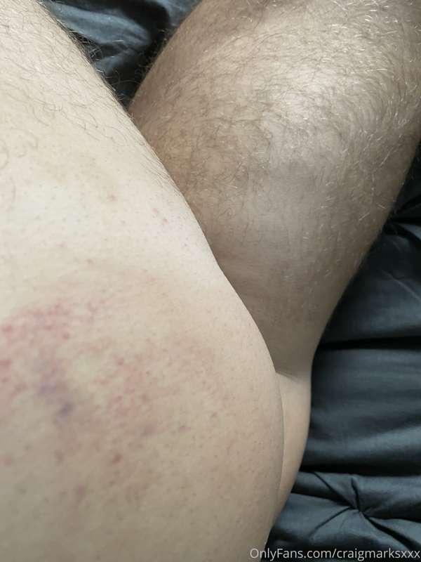 Uh oh… wonder how I got these bruises 😉