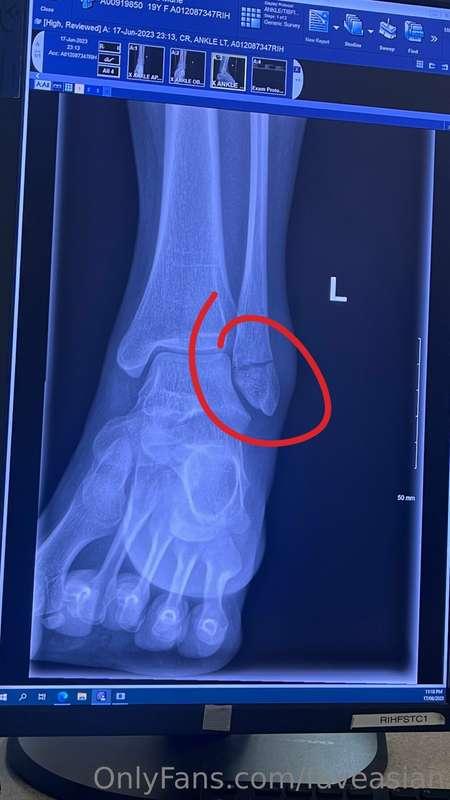 Sorry for not being as active lately, I went to the ER the o..