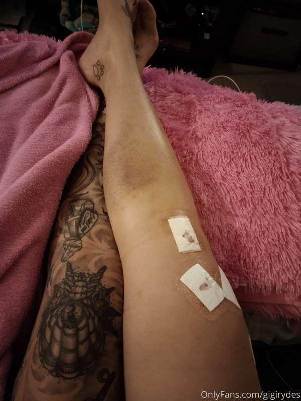 It's been 11 days since my ACL reconstruction surgery and I ..