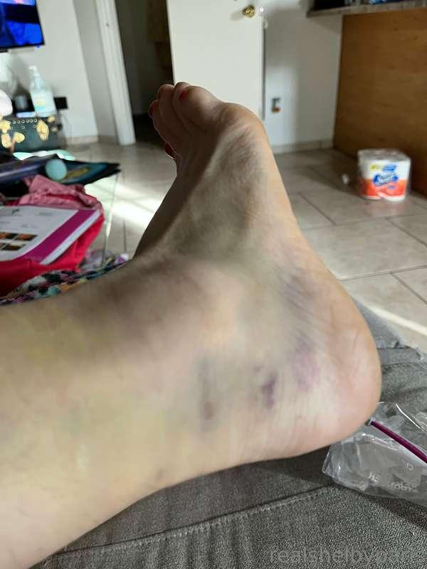 I sprained my ankle 6 months ago & somehow it got resprained..