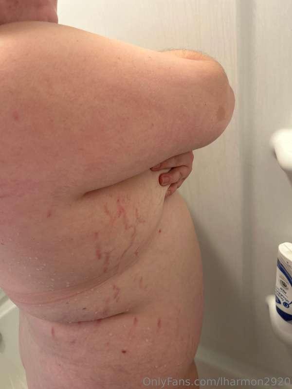 Getting so many stretch marks 