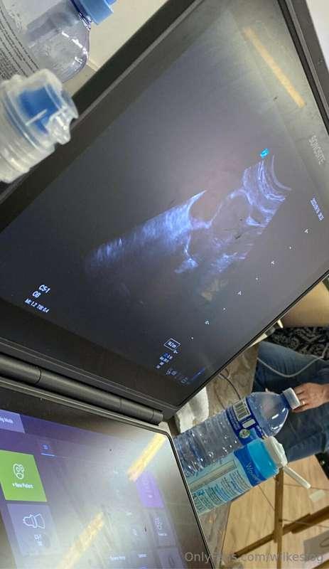 Rare pic of the INSIDE of my uterus, including the vaginal s..