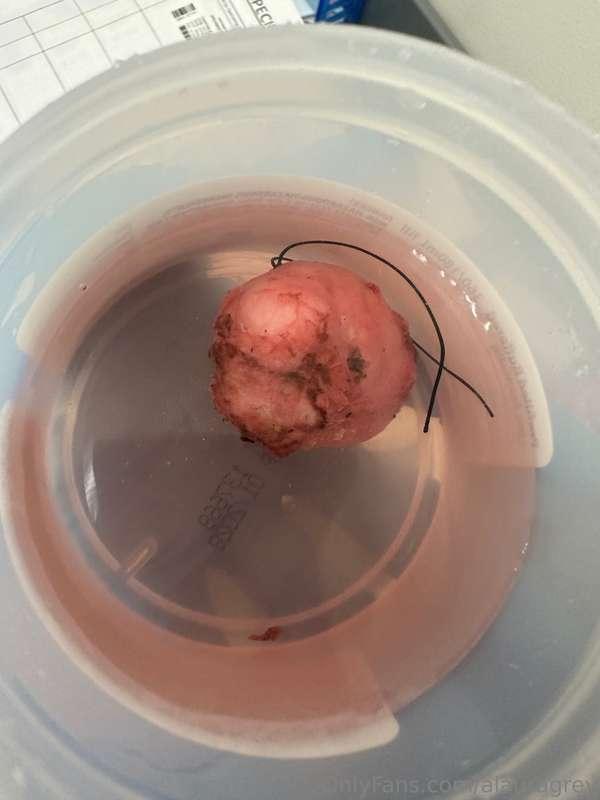 The tumor has been removed! Just resting and recovering this..